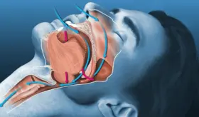 Nuevo fármaco  contra la epilepsia muestra eficacia en el tratamiento de la apnea obstructiva del sueño