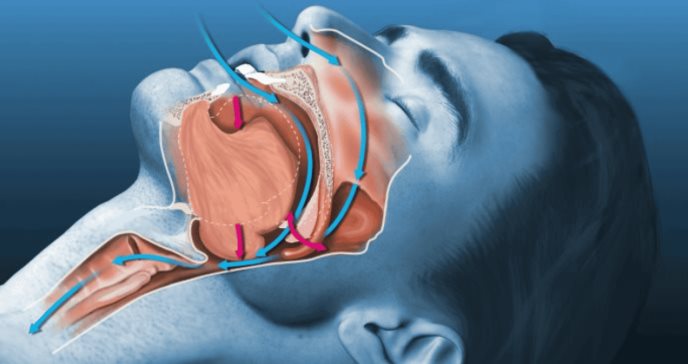 Nuevo fármaco  contra la epilepsia muestra eficacia en el tratamiento de la apnea obstructiva del sueño