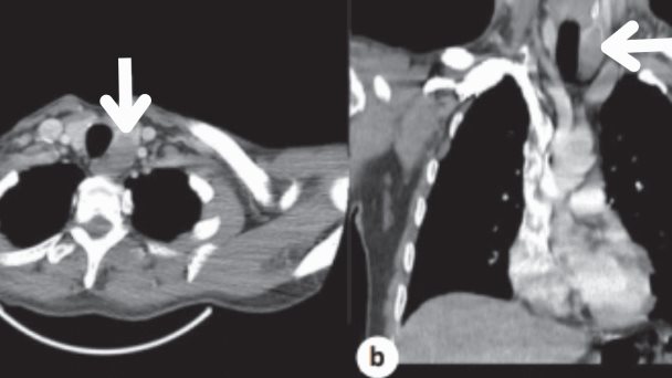 Carcinoma con elementos similares al timo: detectan tumor maligno poco frecuente de la tiroides Carcinoma con elementos similares al timo: detectan tumor maligno poco frecuente de la tiroides