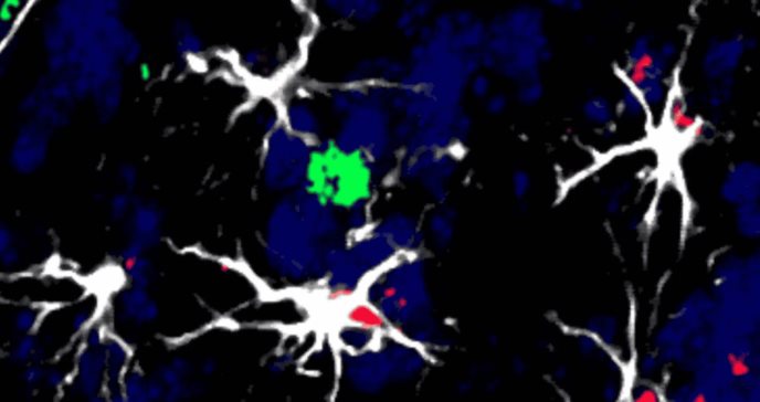 Los astrocitos, inmuno-moduladores del cerebro, podrían corromperse y favorecer la metástasis cerebral 