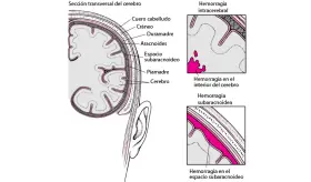¿Qué es una hemorragia subaracnoidea aguda?