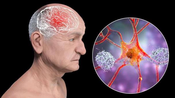 Estas son las enfermedades cardiovasculares que se relacionan con el deterioro cognitivo y la demencia Estas son las enfermedades cardiovasculares que se relacionan con el deterioro cognitivo y la demencia