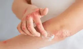 Picazón, dolor y piel enrojecida: síntomas de la dermatitis atópica