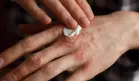 Un corte, raspadura, o picadura sin atención puede desencadenar artritis psoriásica