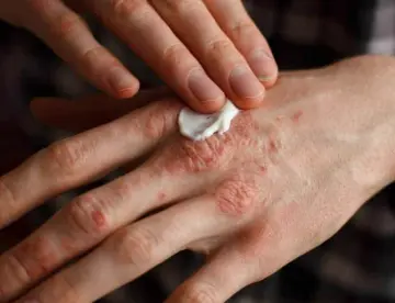 Un corte, raspadura, o picadura sin atención puede desencadenar artritis psoriásica