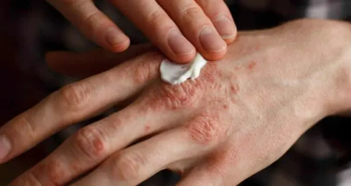 Un corte, raspadura, o picadura sin atención puede desencadenar artritis psoriásica