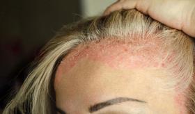 8 de cada 10 pacientes con psoriasis debutan con síntomas en el cuero cabelludo