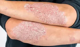 La psoriasis y la artritis psoriásica son enfermedades crónicas que afectan la piel y las articulaciones