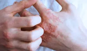 Descubren fármaco más efectivo que la fototerapia para tratar eccema grave en manos