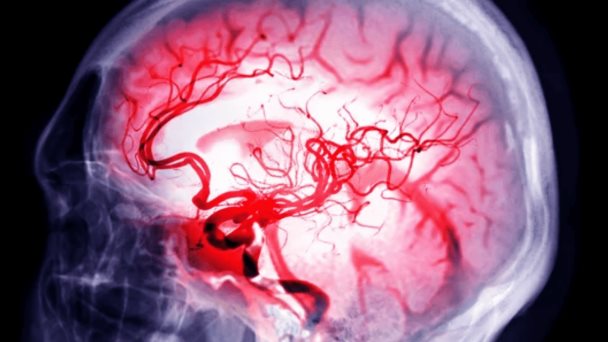 Apatía tras hemorragia intracerebral podría indicar aumento del riesgo de demencia y atrofia cerebral Apatía tras hemorragia intracerebral podría indicar aumento del riesgo de demencia y atrofia cerebral