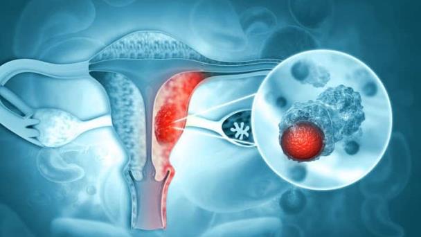 Fármaco para el asma complementaría el tratamiento de cáncer de ovario al superar barreras inmunitarias Fármaco para el asma complementaría el tratamiento de cáncer de ovario al superar barreras inmunitarias