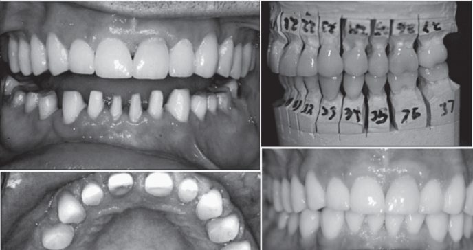 Pérdida dental no cariosa por factores erosivos, fue tratada con una reconstrucción total de la dentadura