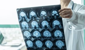 Lucha contra la enfermedad de Huntington: Desarrollan nuevo tratamiento basado en polímeros