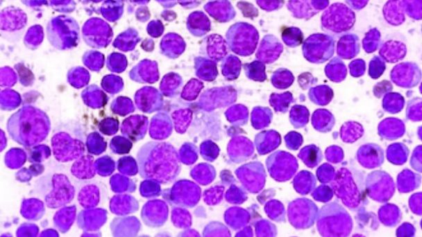 Alteraciones en la producción de células sanguíneas: Síndromes mielodisplásicos Alteraciones en la producción de células sanguíneas: Síndromes mielodisplásicos