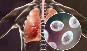 ¿Qué es la Pneumocystis? ¿Qué población se ve más afectada?