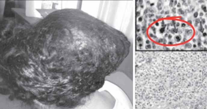 Sarcoma de Ewing en una mujer joven con masa en la región parieto-occipital del cráneo