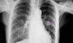 Tuberculosis y neumonía: ¿Por qué no son lo mismo y cómo puede diferenciarlas?