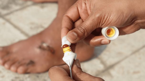 Desarrollan nuevo tratamiento con hidrogel para úlceras y heridas de difícil cicatrización Desarrollan nuevo tratamiento con hidrogel para úlceras y heridas de difícil cicatrización