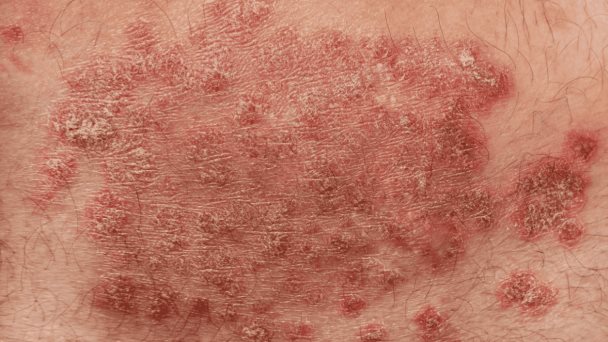 Nueva infección fúngica de transmisión sexual afectaría principalmente a hombres Nueva infección fúngica de transmisión sexual afectaría principalmente a hombres