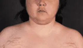 Cara de luna: Síntomas de los niveles altos de cortisol y su confusión con otras enfermedades