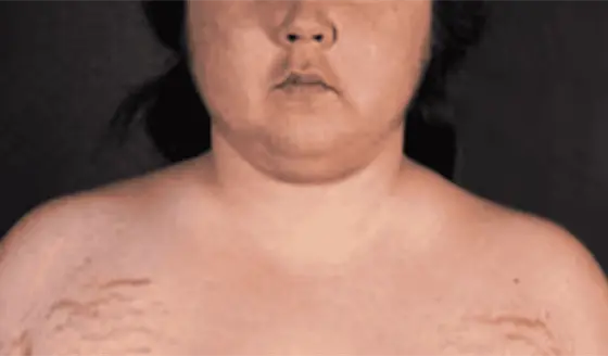 Cara de luna: S&iacute;ntomas de los niveles altos de cortisol y su confusi&oacute;n con otras enfermedades