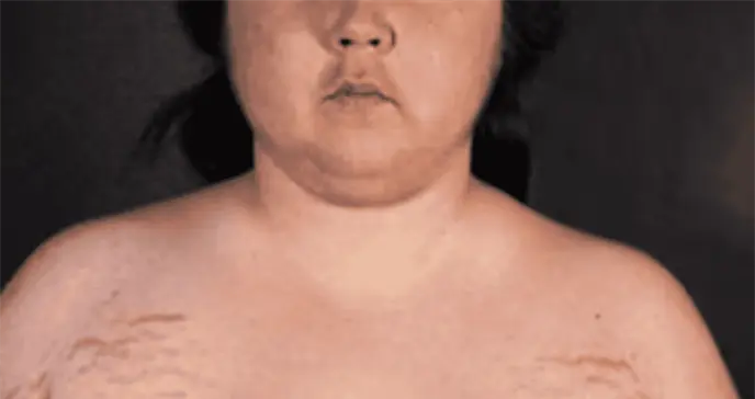 Cara de luna: Síntomas de los niveles altos de cortisol y su confusión con otras enfermedades Cara de luna: Síntomas de los niveles altos de cortisol y su confusión con otras enfermedades