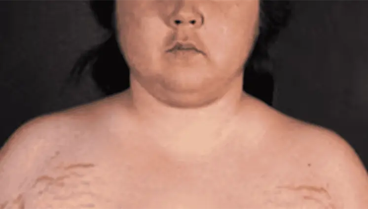 Cara de luna: Síntomas de los niveles altos de cortisol y su confusión con otras enfermedades