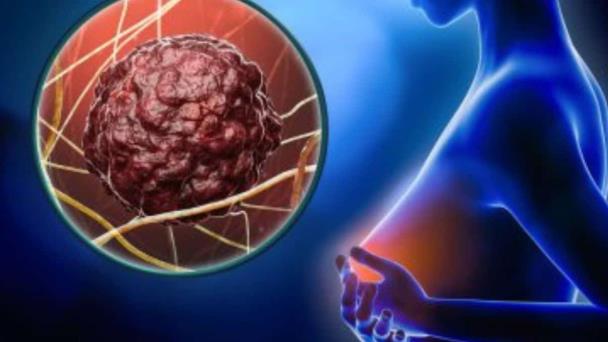 Científica trata su propio cáncer de mama con virus desarrollado en su laboratorio Científica trata su propio cáncer de mama con virus desarrollado en su laboratorio