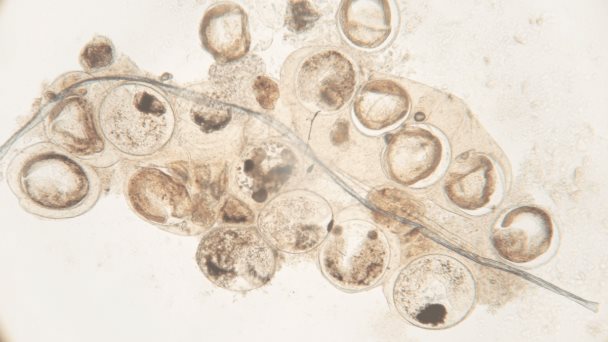 Se presentan 3 infecciones parasitarias gastrointestinales simultáneas en un paciente con VIH Se presentan 3 infecciones parasitarias gastrointestinales simultáneas en un paciente con VIH