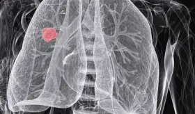 Expertos señalan que ha aumentado la supervivencia del cáncer de pulmón, pero persisten retos médicos 