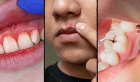 Caries, periodontitis y aftas bucales: Principales problemas bucodentales en pacientes con VIH