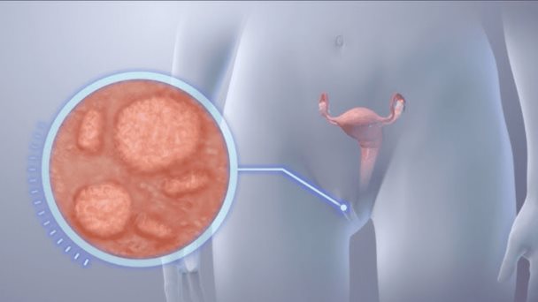 Herpes genital y oral: Terapia génica experimental abre la puerta a la cura  