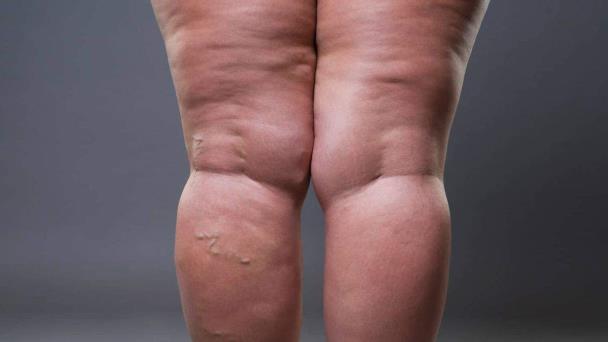 Por qué el lipedema y las ‘piernas gruesas’ no son lo mismo: ¿Cómo diferenciarlas? Por qué el lipedema y las ‘piernas gruesas’ no son lo mismo: ¿Cómo diferenciarlas?