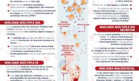 Tipos de mieloma múltiple | Infografía