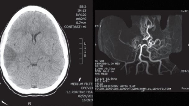 Mujer con migraña, visión borrosa y accidente cerebrovascular es diagnosticada con enfermedad de moyamoya Mujer con migraña, visión borrosa y accidente cerebrovascular es diagnosticada con enfermedad de moyamoya