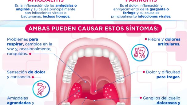 AMIGDALITIS Y FARINGITIS AMIGDALITIS Y FARINGITIS