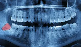 Joven de 17 a&ntilde;os fallece tras complicaciones con la anestesia en una cirug&iacute;a de cordales