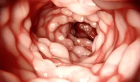 Alimentos ultraprocesados aumentan el riesgo de desarrollar cáncer colorrectal y alzhéimer