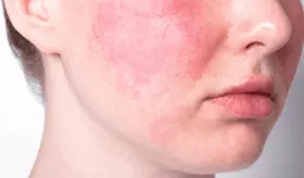 Desarrollan nuevo tratamiento para la rosácea que promete reducir inflamación y picazón