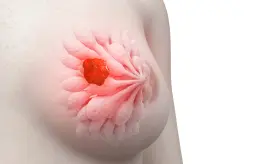 Combinación de imlunestrant y abemaciclib mejora supervivencia en cáncer de mama avanzado, según estudio