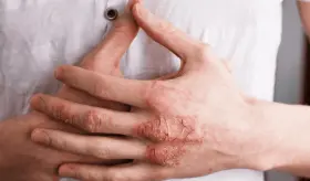 Cómo la inflamación afecta a la psoriasis y qué hábitos pueden aliviar sus síntomas