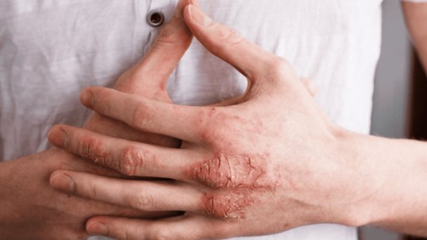 Cómo la inflamación afecta a la psoriasis y qué hábitos pueden aliviar sus síntomas Cómo la inflamación afecta a la psoriasis y qué hábitos pueden aliviar sus síntomas