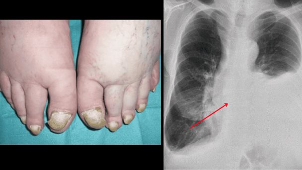 Síndrome de uña amarilla asociado al crecimiento anormal de las células de grasa entre los pulmones Síndrome de uña amarilla asociado al crecimiento anormal de las células de grasa entre los pulmones