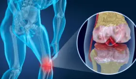 Desarrollan prueba basada en líquido sinovial para diagnosticar artritis de rodilla en primeras etapas