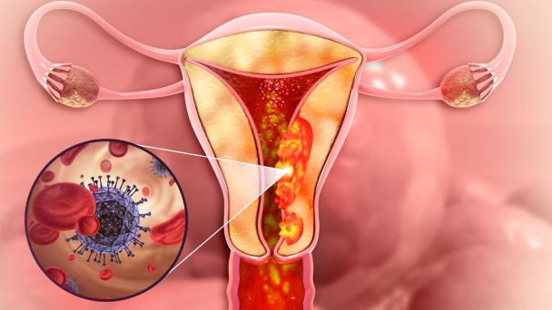 La incidencia más alta de cáncer cervical en EE. UU. se registra entre las mujeres latinas La incidencia más alta de cáncer cervical en EE. UU. se registra entre las mujeres latinas
