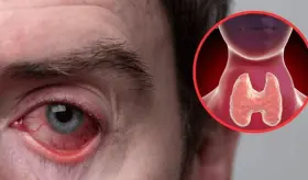 Esto es todo lo que debes saber sobre la Enfermedad Ocular Tiroidea