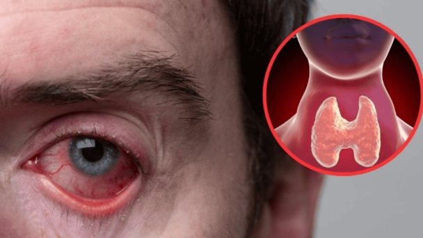 Esto es todo lo que debes saber sobre la Enfermedad Ocular Tiroidea Esto es todo lo que debes saber sobre la Enfermedad Ocular Tiroidea