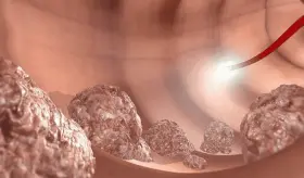 La colonoscopia asistida por IA mejora la detección de pólipos colorrectales premalignos, según estudio