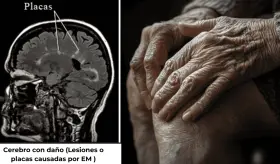 La menopausia aceleraría la progresión de la esclerosis múltiple: Deteriora la movilidad y cognición  