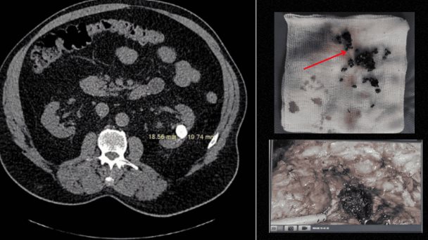Hallan piedra infectada de 2 cm en el parénquima renal junto a múltiples cálculos en paciente de 65 años